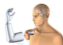 В Мексике создан функциональный протез, соединяющийся с нервами и мышцами