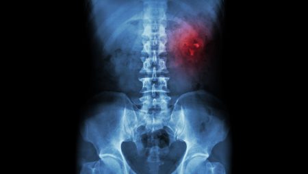 Специалисты Mayo Clinic создали онлайн-инструмент для предсказания вероятности образования камней в почках Специалисты Mayo Clinic создали онлайн-инструмент для предсказания вероятности образования камней в почках