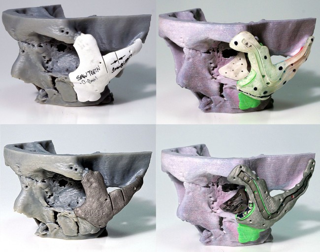 Технология 3D-печати помогла британским хирургам восстановить форму лица пациента