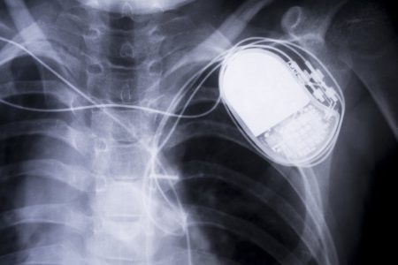 FDA впервые признало, что некоторые кардиостимуляторы уязвимы для взлома