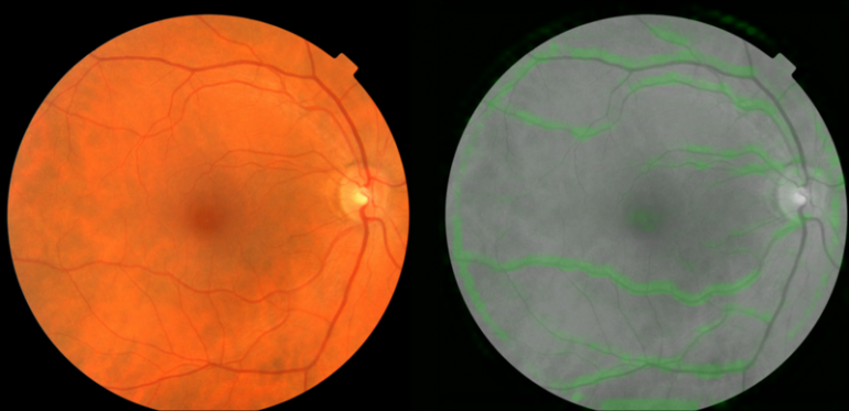 Алгоритмы ИИ Google теперь могут предсказывать сердечные заболевания, просто взглянув в глаза человека