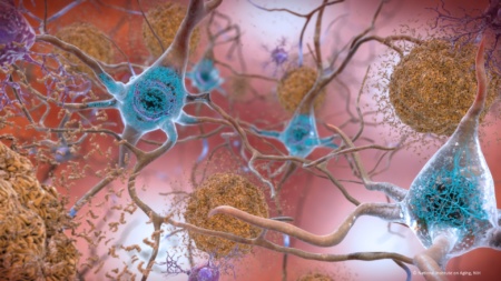 Biogen разработала новый перспективный препарат против болезни Альцгеймера