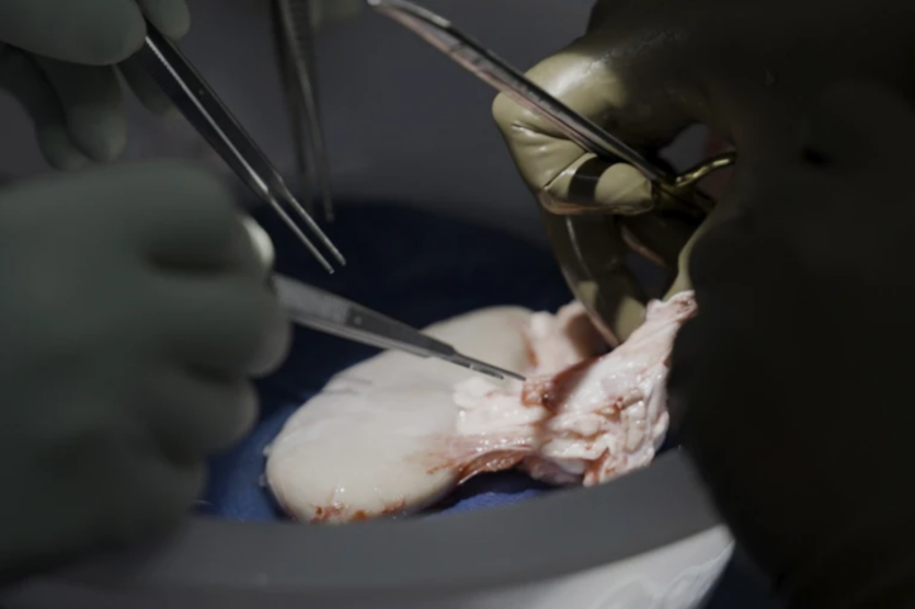 Нирка свині вже понад місяць функціонує в тілі людини — це рекорд