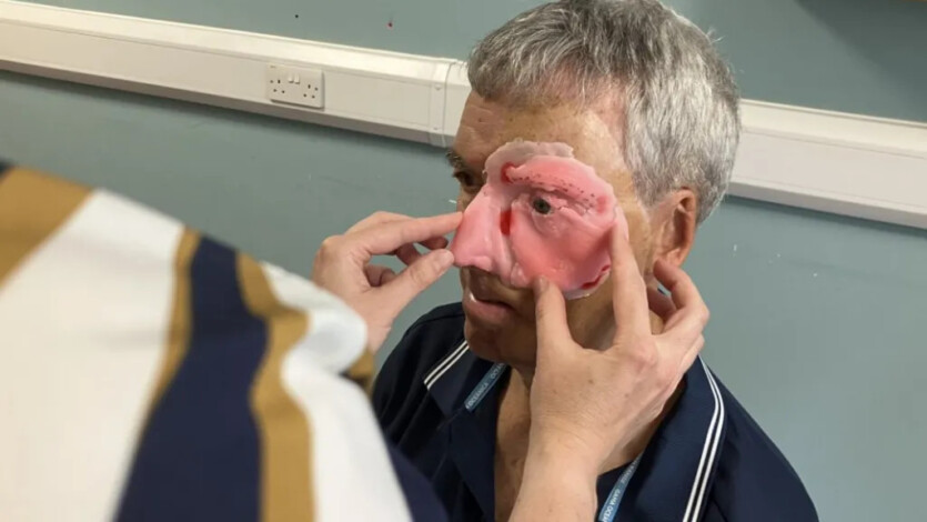 Face made of 3D printer — British man is the first in the world to receive an unusual prosthesis
