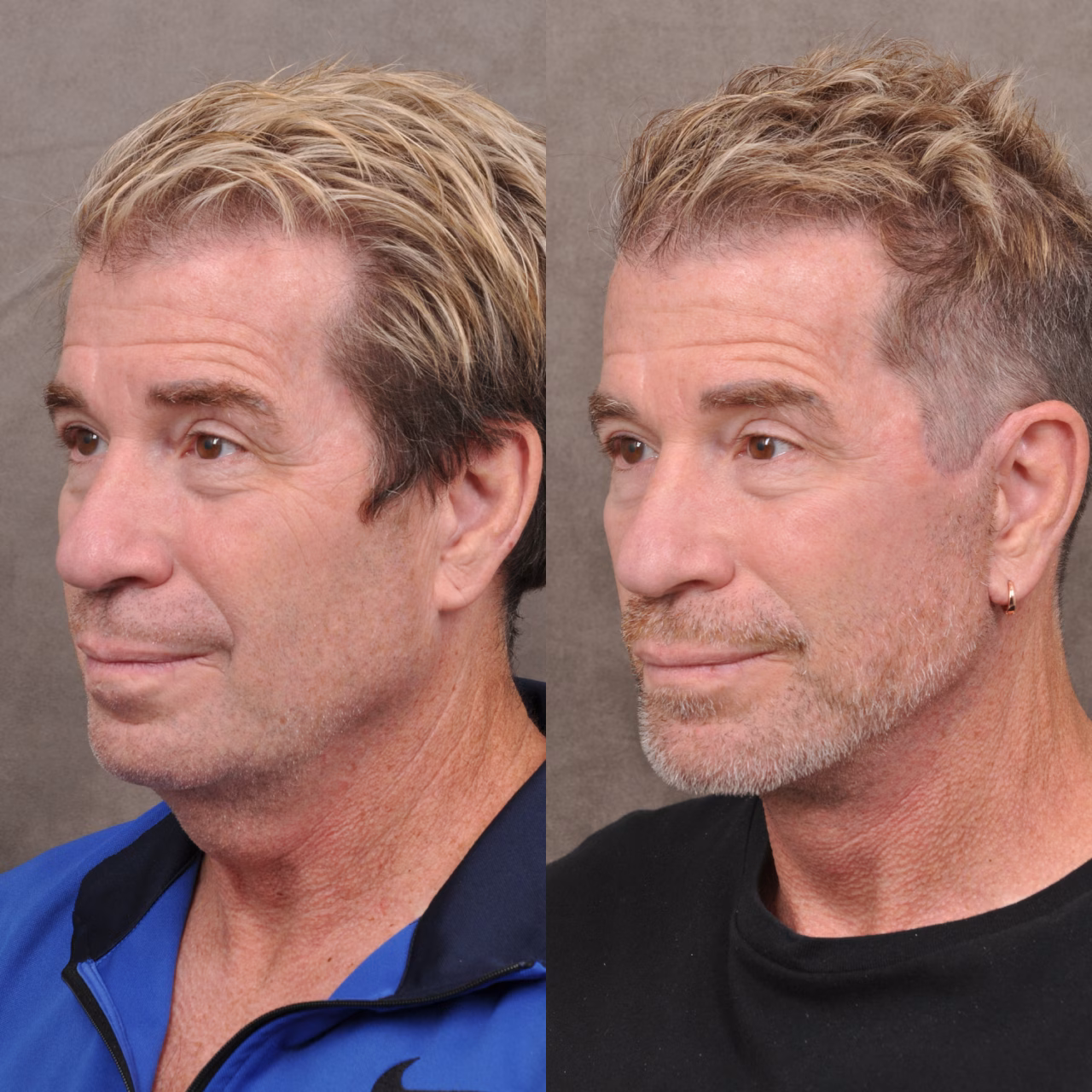 65-річний бізнес-консультант та радник з питань капіталу підприємців у сфері технологій, який зробив глибоку підтяжку обличчя та шиї. Фото надані доктором Беном Талеєм з дозволу пацієнта.