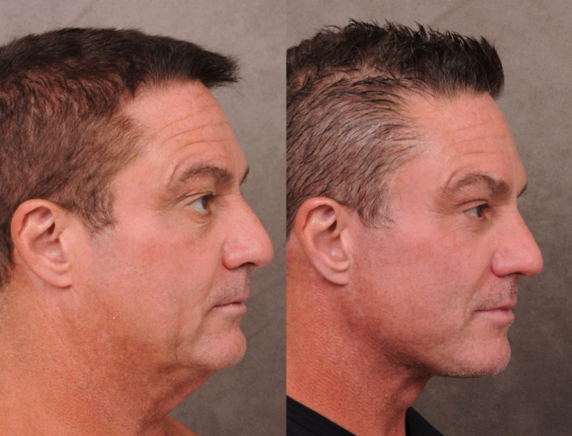 WSJ: Айтівці Кремнієвої долини роблять підтяжки, щоб не втратити роботу через вік