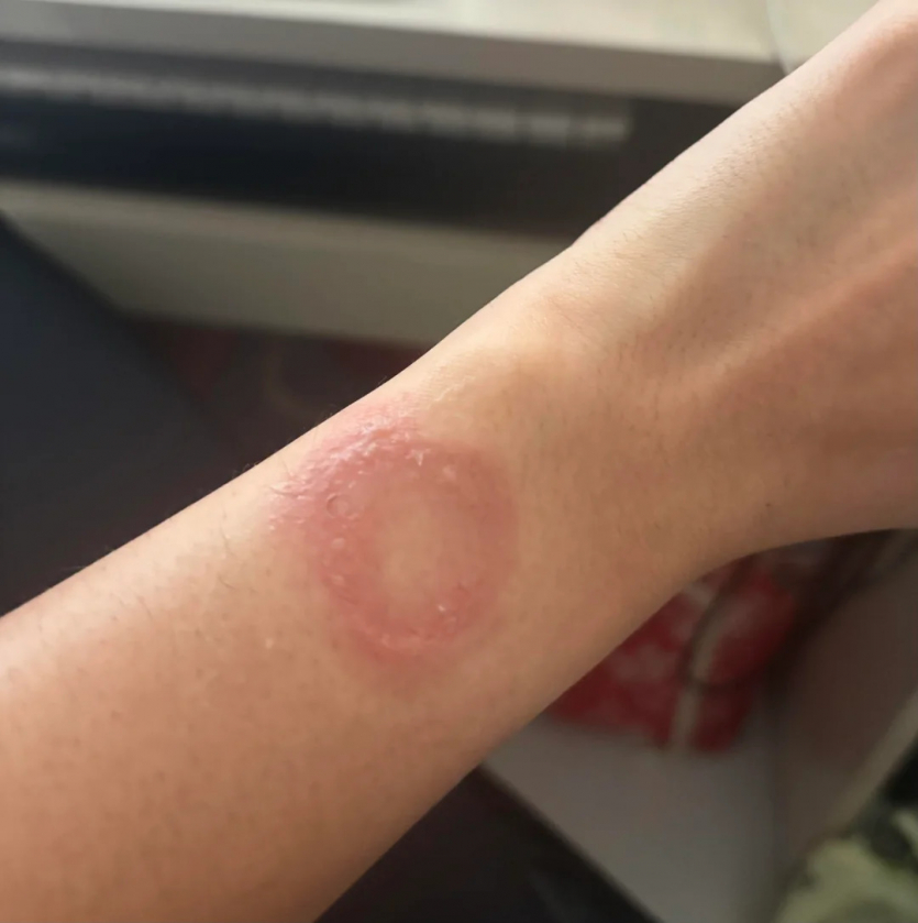 Власник Apple Watch поскаржився на опік зап'ястя: Apple не реагує на скаргу