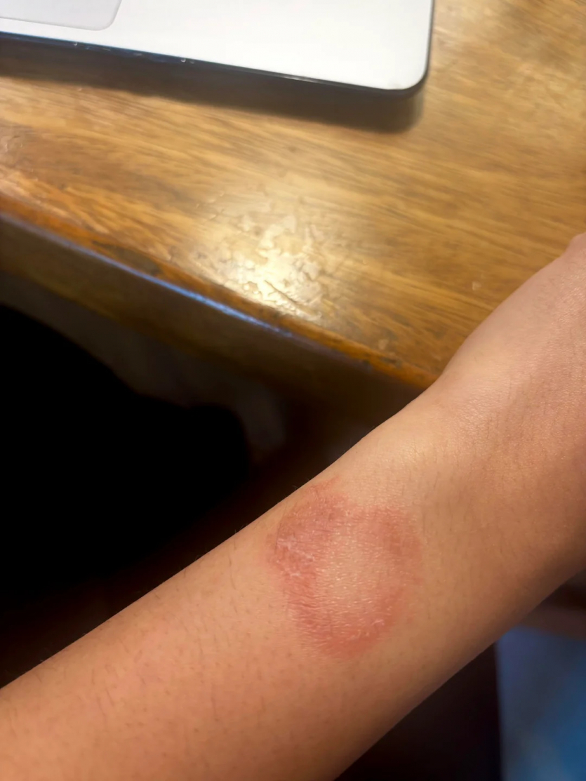 Власник Apple Watch поскаржився на опік зап'ястя: Apple не реагує на скаргу